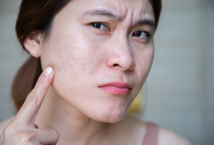 痘痘反覆長？中醫揭「2型濕熱」體質惹禍 下巴長痘恐是吃冰害的