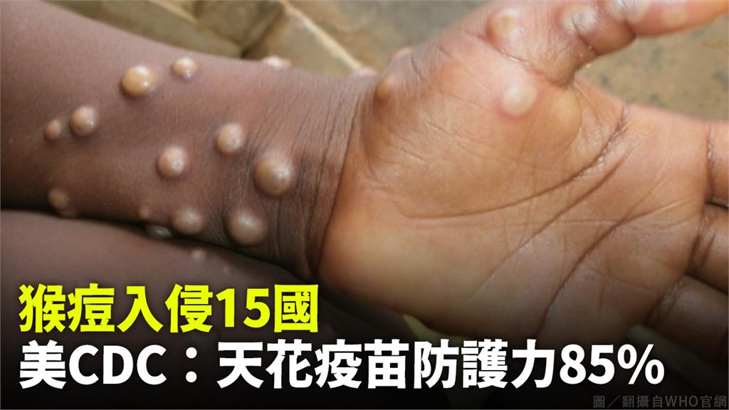 目前至少已經有15個國家出現猴痘病例。圖／翻攝自AP Direct