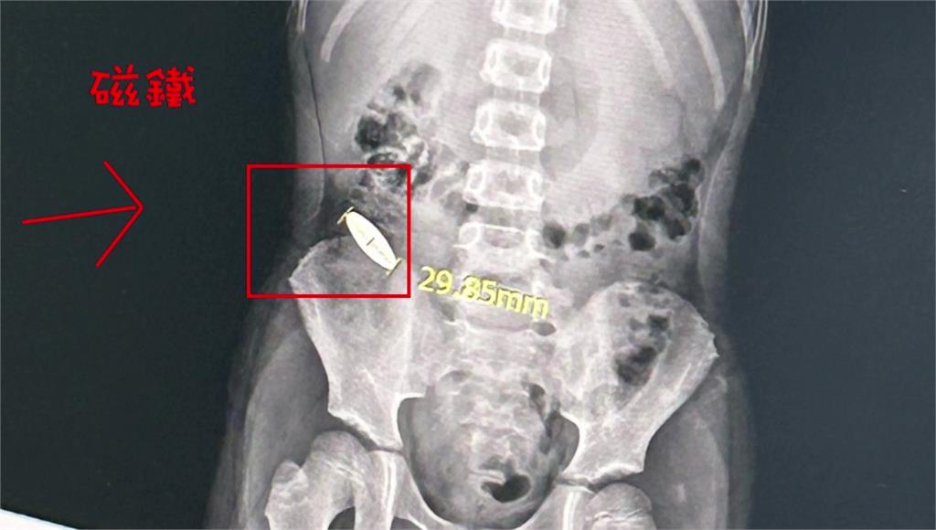 台南小一童不想和補習班小五生玩 疑遭霸凌「逼吞3公分磁鐵」