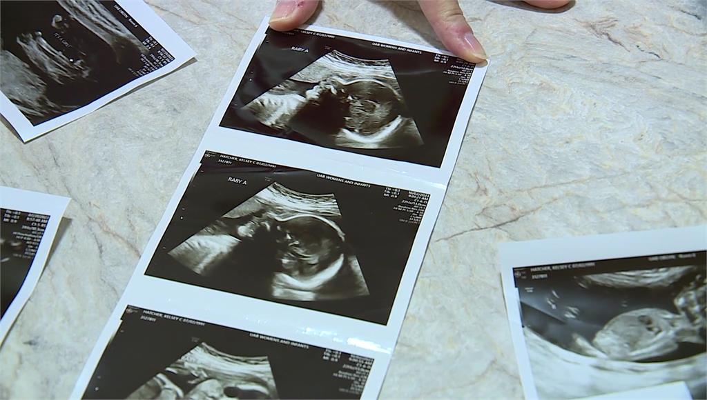 美國3寶媽懷孕，雙子宮竟「同時受孕」。圖／CNN