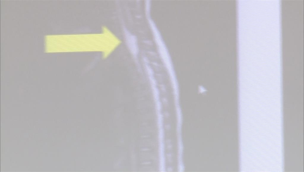 2歲女童神經腸囊腫壓迫脊髓神經，導致莫名尖叫、雙腳癱瘓、失禁等情況。圖／台視新聞