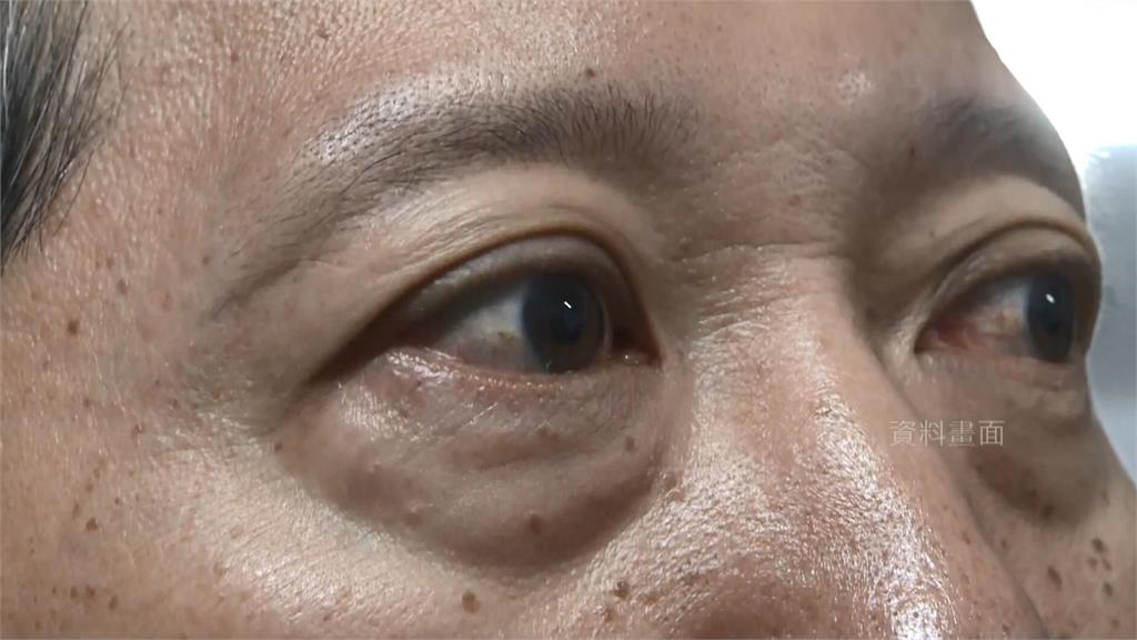 虹彩炎會造成眼睛畏光、疼痛，嚴重時視力也會受損。圖／台視新聞