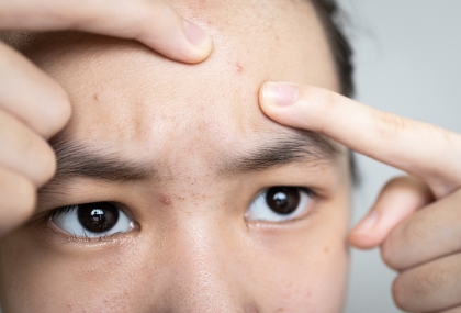 擠痘痘竟害肺破洞！醫示警「臉部致命三角區」千萬別亂碰