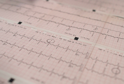 心房顫動中風風險怎麼評估？臺大AI模型助攻個人化精準醫療