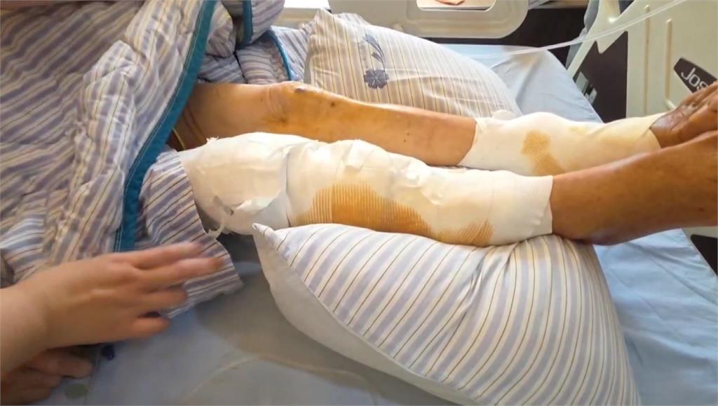 3犬隻突襲擊追咬！彰化76歲婦全身「200多處傷口」 忍痛找鄰居求救