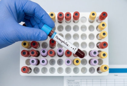 為何瘀青特別多？小心血友病 早期診斷可避免關節變形