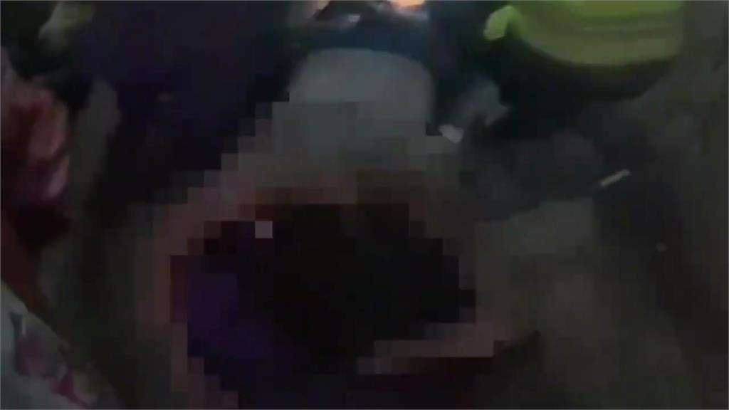 男緊張吞「3顆子彈」引發鉛中毒！ 跌地下室腿骨折曝案外案