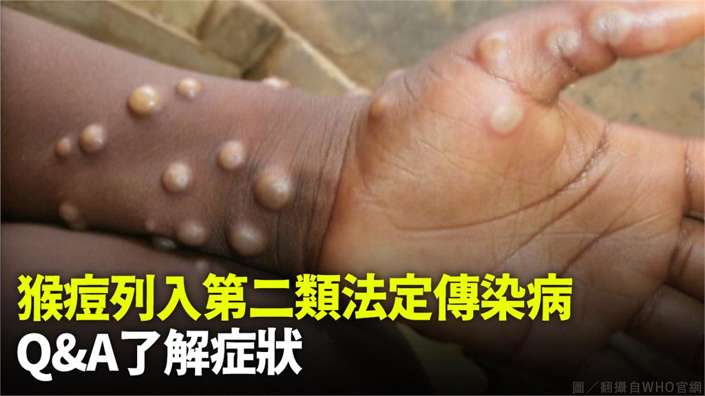 猴痘列入第二類法定傳染病。圖／翻攝自WHO