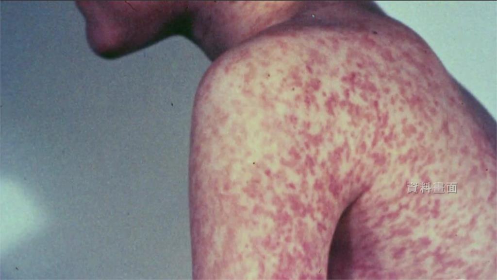 疾管署表示，近期無再新增麻疹確診病例。圖／台視新聞（資料畫面）