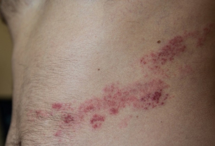 帶狀皰疹像被火燒！神經科醫師警告：劇痛先來、延誤恐留後遺神經痛