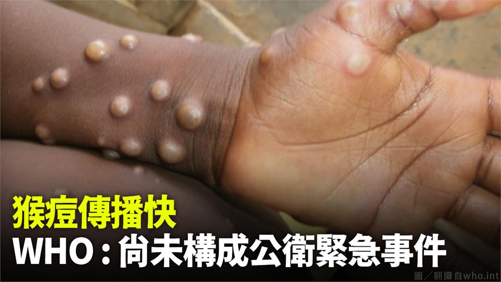 WHO表示猴痘尚未構成公衛緊急事件。圖／翻攝自who.int
