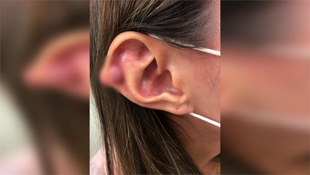 女大生打耳洞長肉瘤，得用長髮遮2顆「花生」。圖／台視新聞