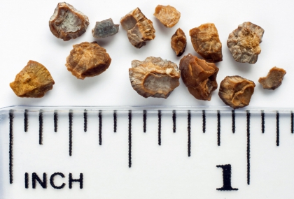 結石痛到想打滾？醫揭形成原因、好發族群與關鍵警訊