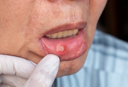 嘴破反覆不癒合 男子就醫驚覺口腔癌第二期