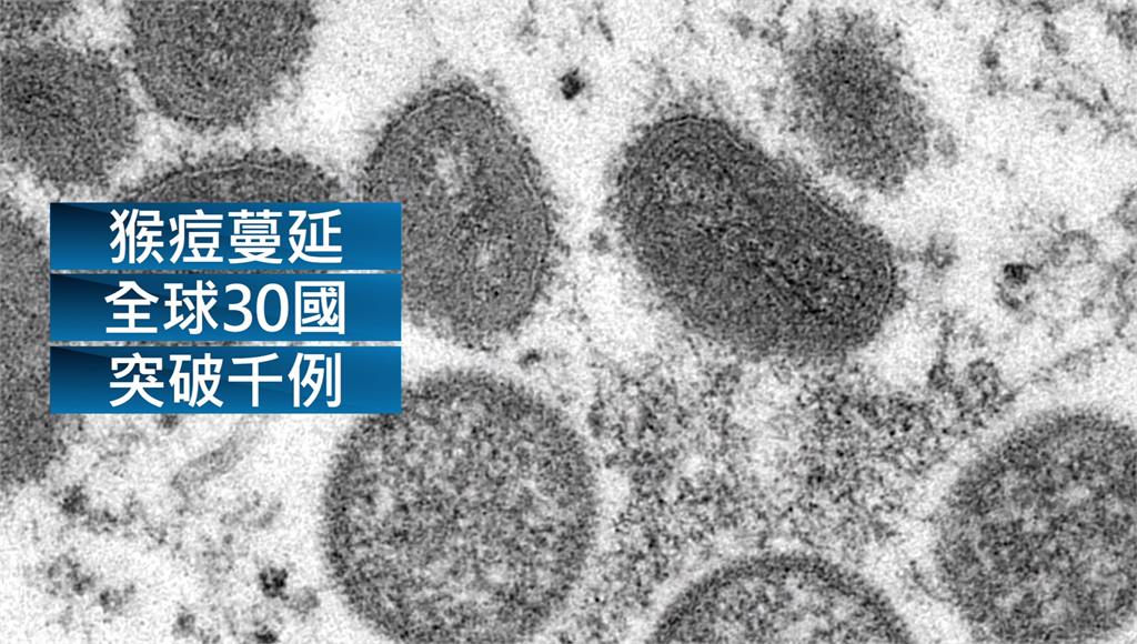 猴痘疫情蔓延30多國 全球總確診數破千例