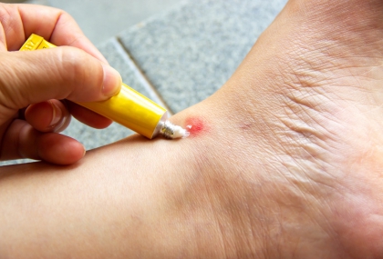 外用類固醇藥膏「這樣用」恐誘發糖尿病！藥師示警  擦多不會更快好