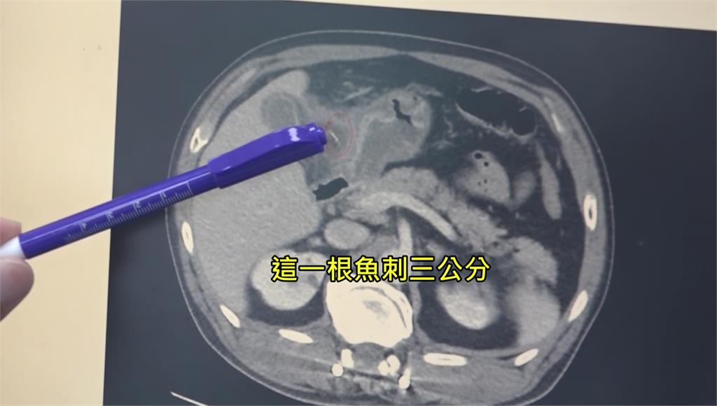 嚇！3cm魚刺害胃穿孔　男子膽囊炎手術切除